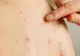Autoritățile sanitare, în alertă. Au fost confirmate încă 6 cazuri de rujeolă